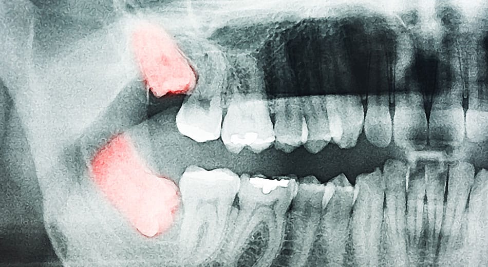 Top Reasons For Extracting Impacted Or Problematic Wisdom Teeth   Wisdom Tooth 