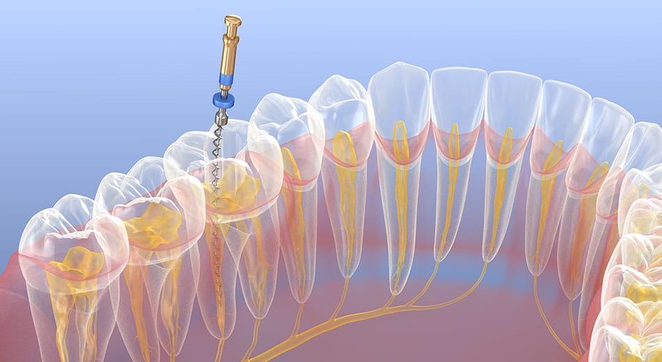 Root Canals Answers To Your Top Questions Stephen Petinge DMD   Root Canal 950 